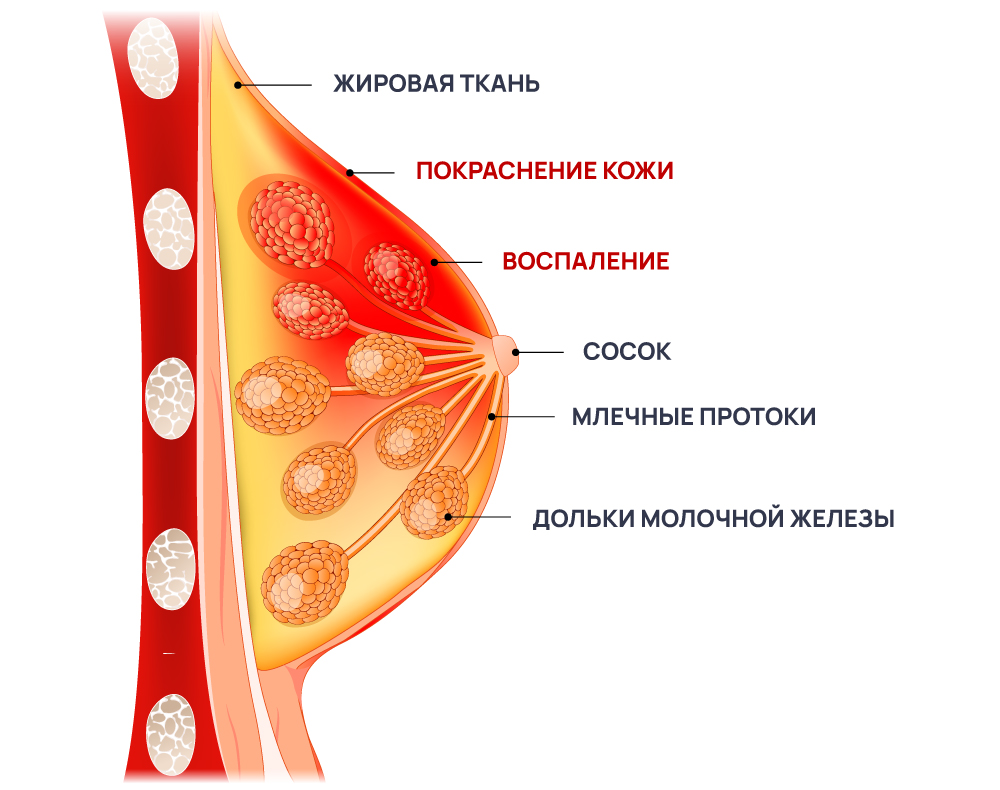 Симптомы мастита