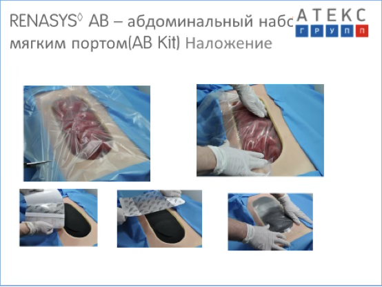 Вакуум-ассистированное закрытие раны брюшной стенки - V.A.C. TM.
Этапы установки системы.