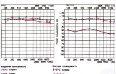 Что такое аудиограмма?
