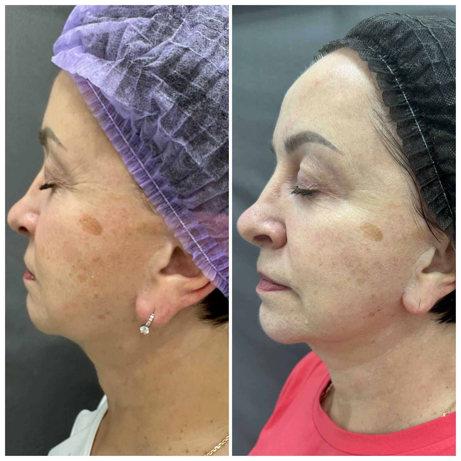 Результаты до и после