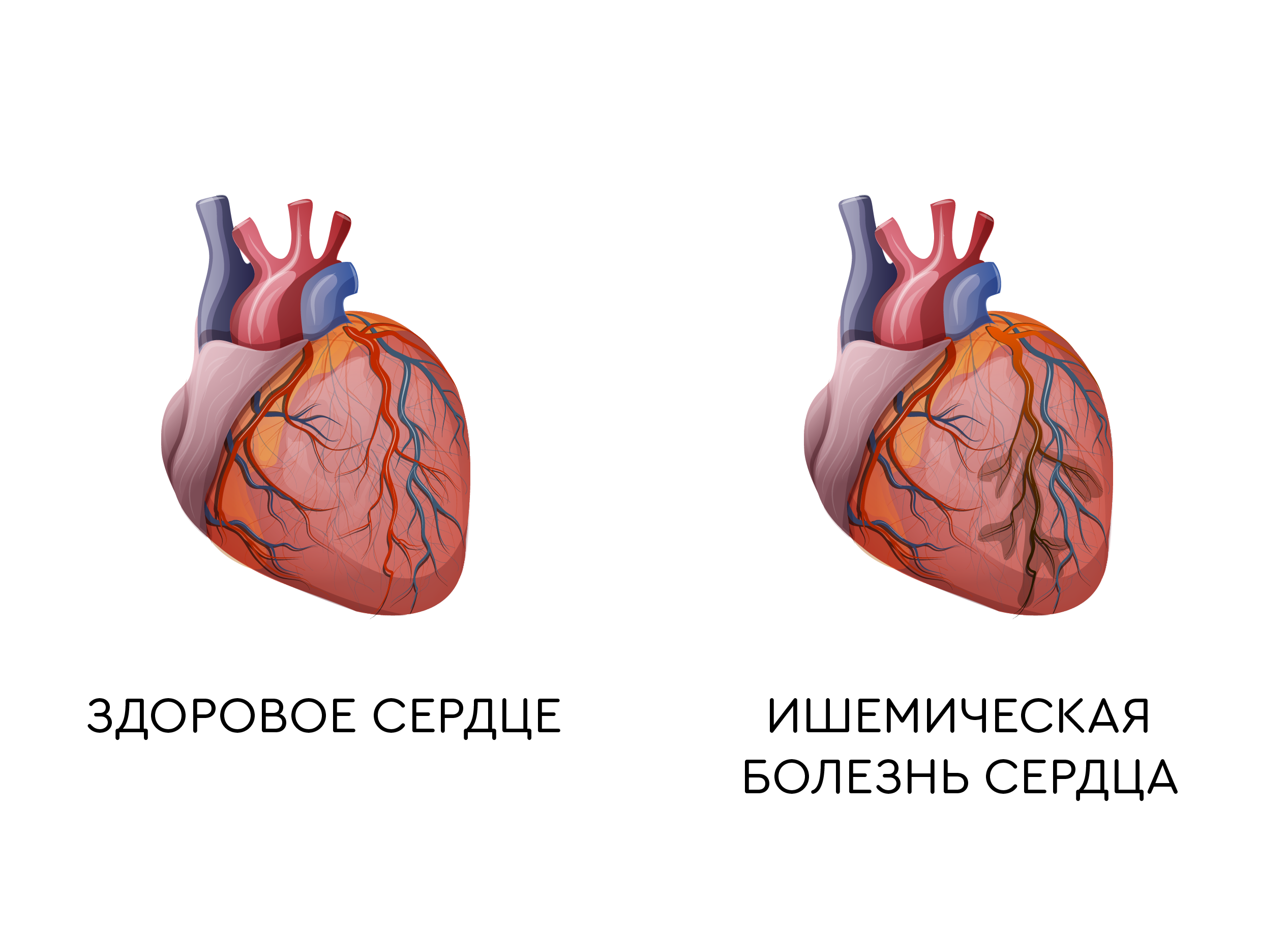 Ишемия мышц. Ишемическая болезнь сердца инфаркт миокарда. Симптомы ИБС инфаркт миокарда. Строение сердца при инфаркте миокарда. Здоровое и больное сердце.