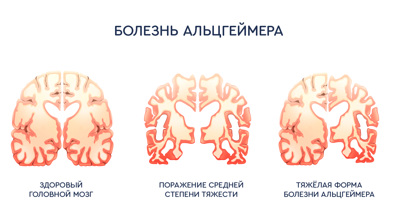 Лучше альцгеймер чем паркинсон картинка смешная