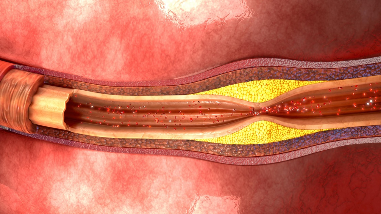 Бляшки в сосудах фото
