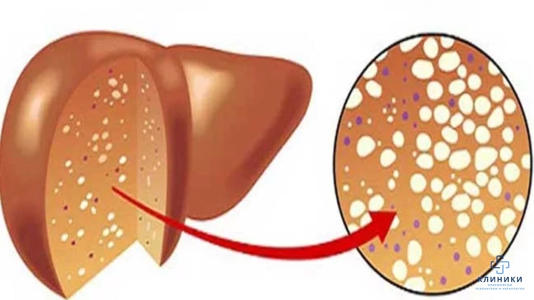 Жировой гепатоз