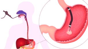 Болезнь Крона