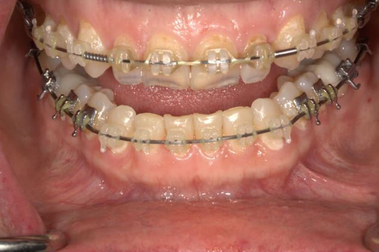 A view of teeth with vaping-related tooth decay.