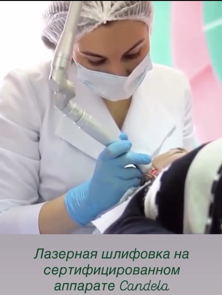 Лазерная шлифовка на аппарате CANDELA