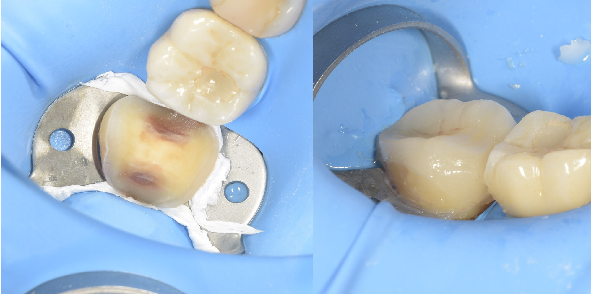 Коффердам при адгезивной фиксации виниров/коронок/накладок