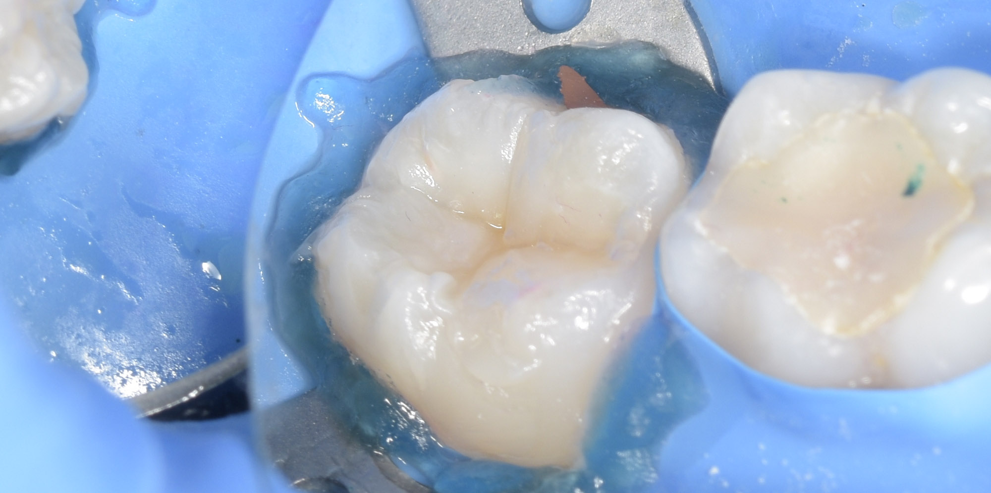 Жидкий коффердам вокруг зуба