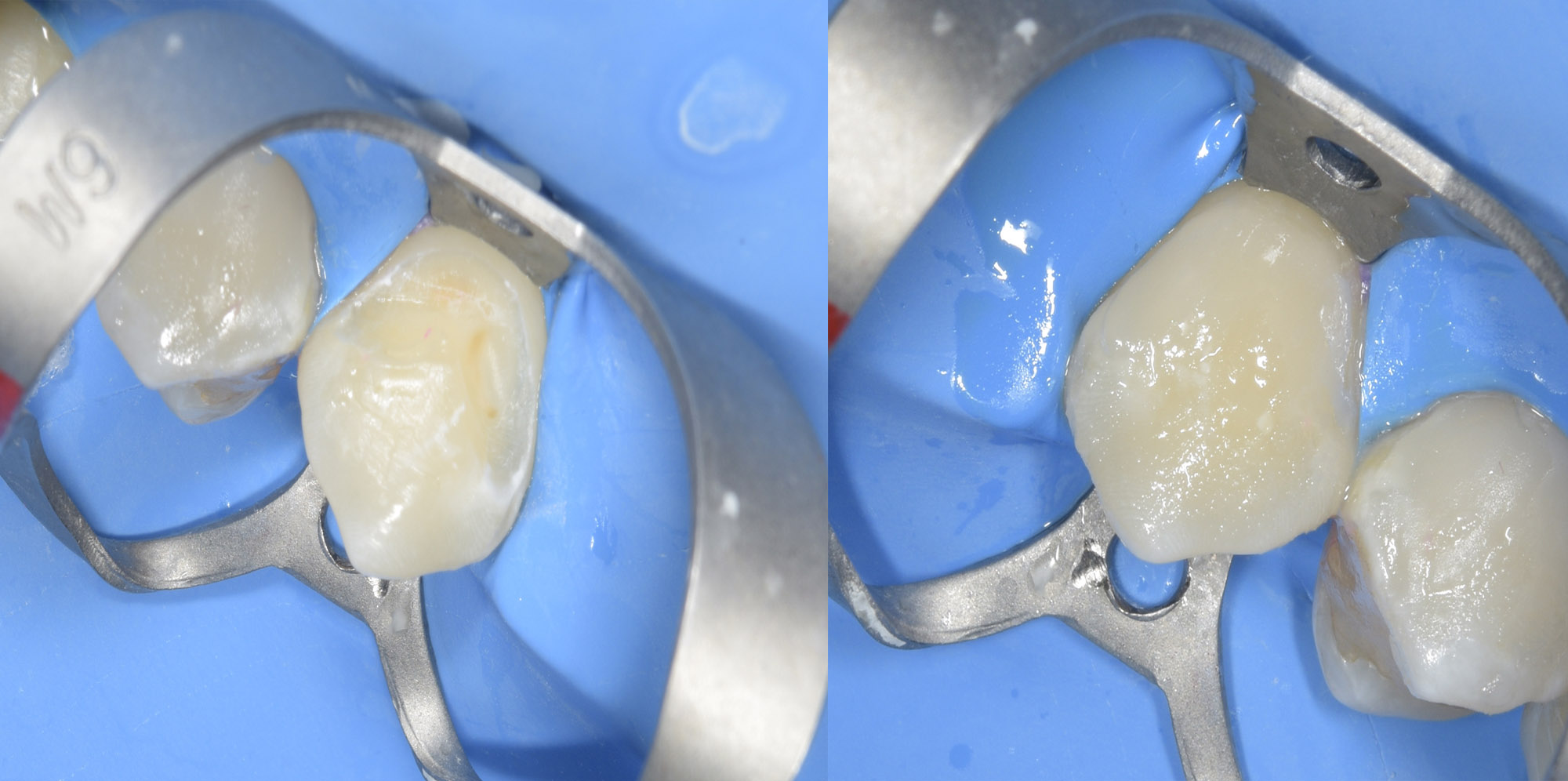 Другие клинические ситуации с коффердамом