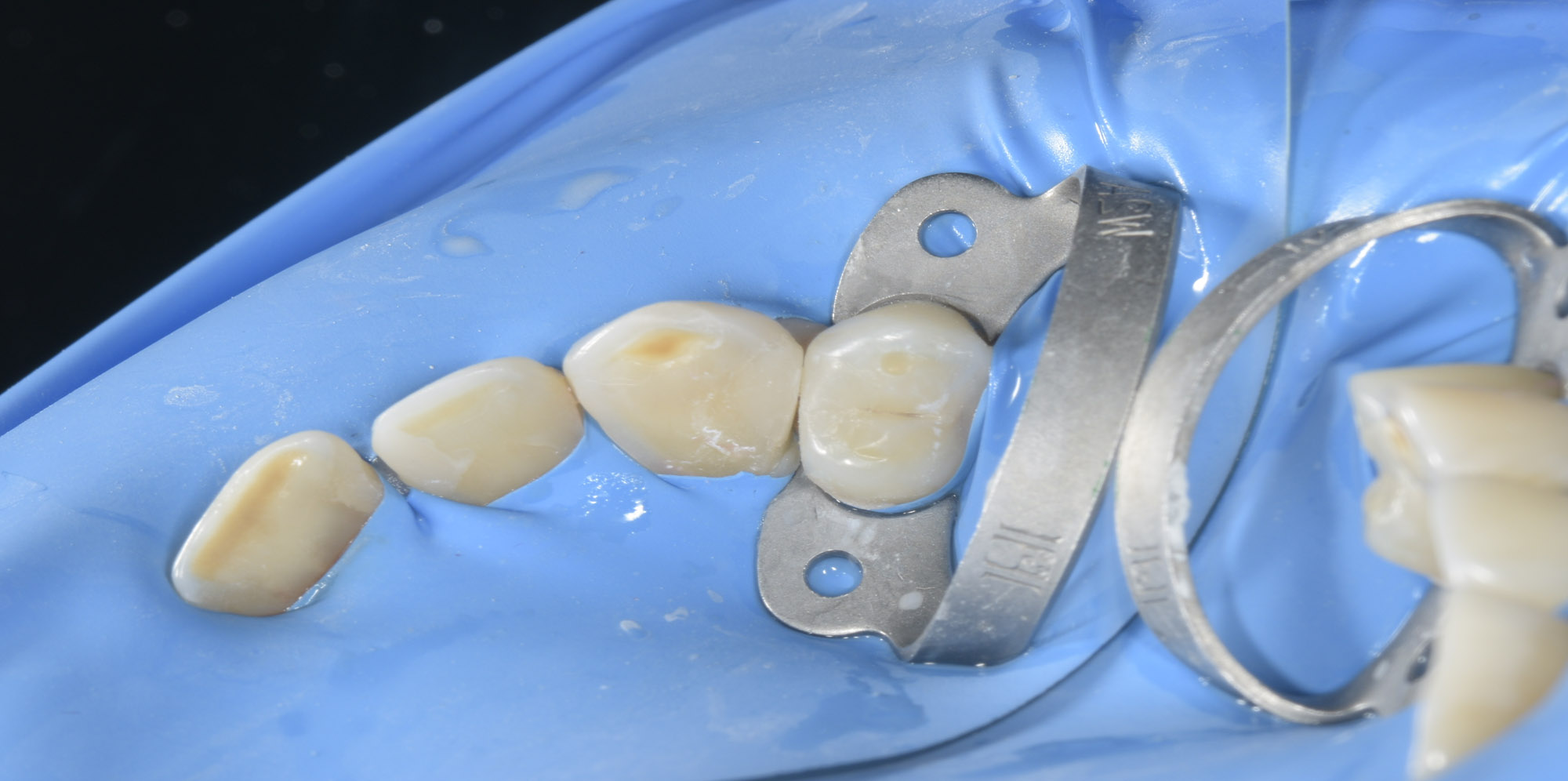 Коффердам защищает дыхательные пути при работе стоматолога