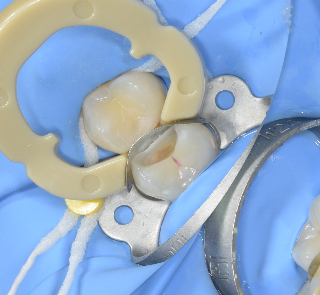 Коффердам при установке пломбы