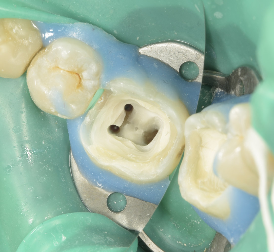 Изоляция коффердамом при эндодонтическом лечении