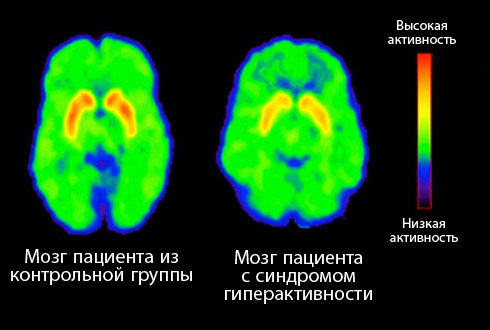Изменения в мозгу