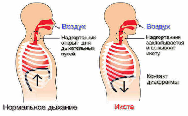 Почему возникает икота - схема