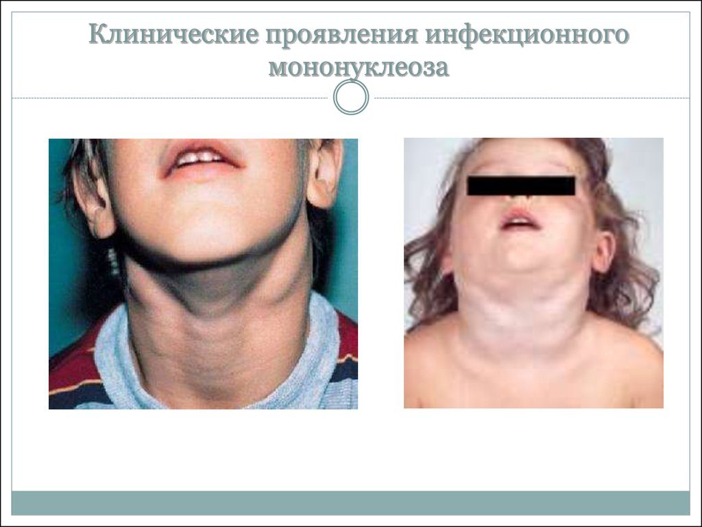 Увеличение лимфоузлов при мононуклеозе