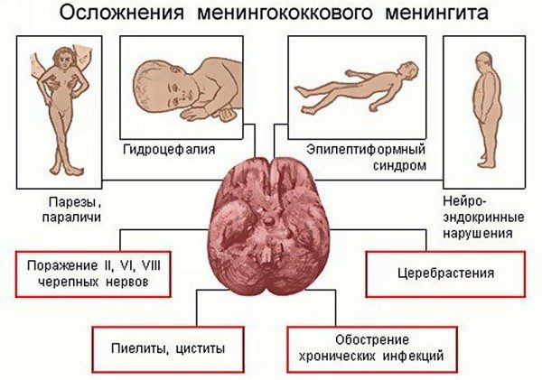 Осложнения менингита