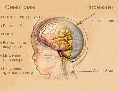 Симптомы менингита