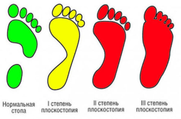 Способы лечения плоскостопия у детей - 3 легких способа