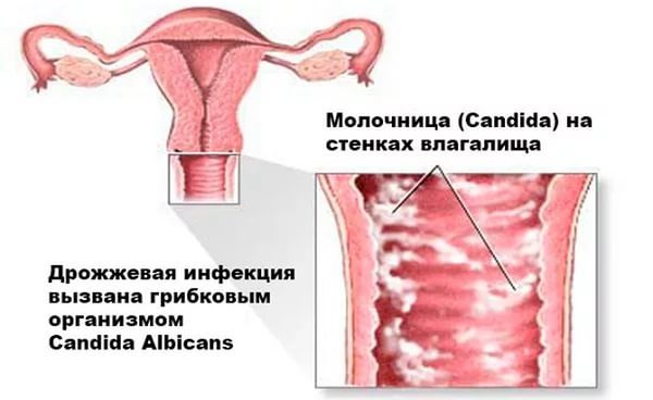 Что такое молочница