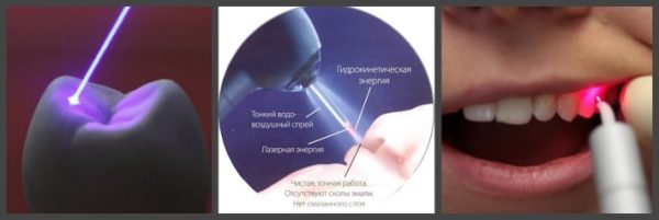Современные методы лечения кариеса у детей