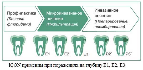 Современные методы лечения кариеса у детей