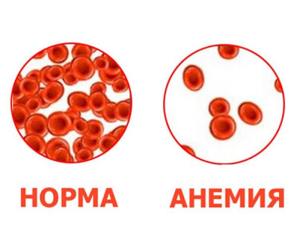 Норма и анемия