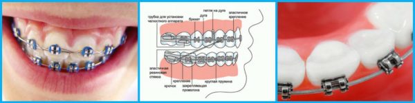 Как исправить прикус