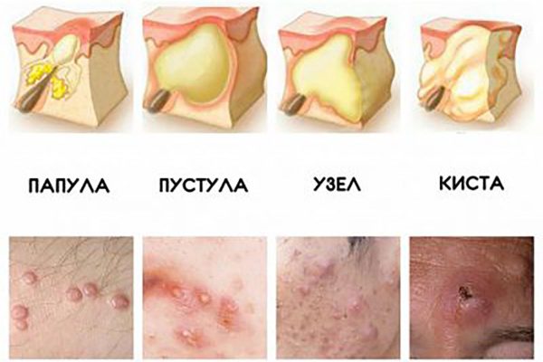 Подростковые прыщи - как пережить сложный гормональный период с наименьшими психологическими проблемами