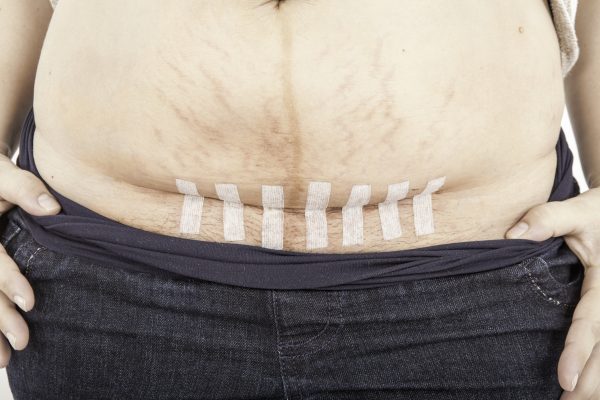 3 эффективных шага, позволяющих быстро убрать живот после кесарева сечения