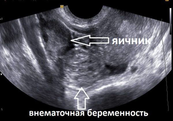 Внематочная беременность: причины и сможет ли женщина еще выносить ребенка