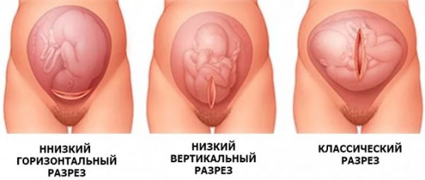 3 эффективных шага, позволяющих быстро убрать живот после кесарева сечения