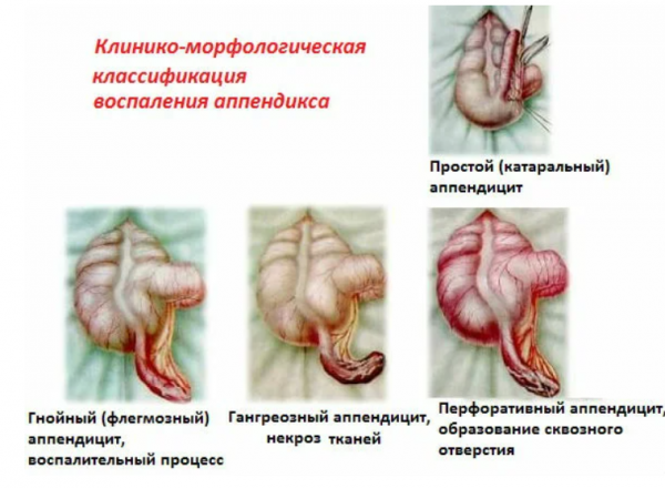 Аппендицит у малышей: как распознать и что категорически нельзя делять