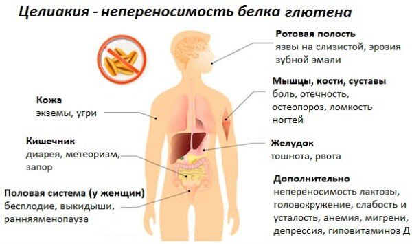 Целиакия у детей - как жить и какие последствия