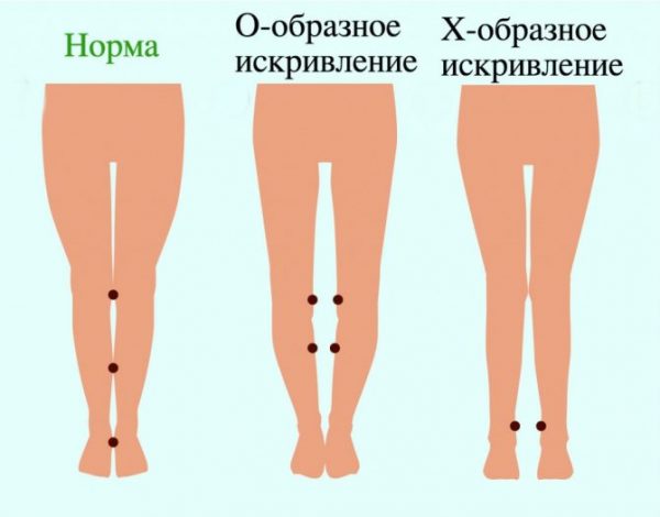 Кривые ножки у малыша: в каких случаях бить тревогу
