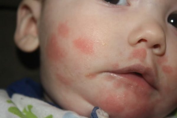 Непереносимость грудного молока: как распознать вовремя и что делать