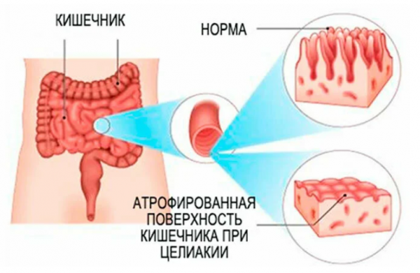 Целиакия у детей - как жить и какие последствия