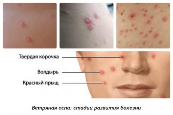 Стадии высыпаний ветрянки