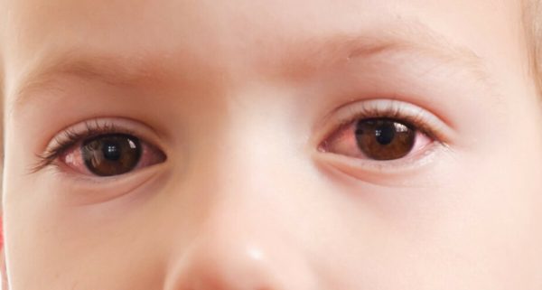 Conjunctivitis