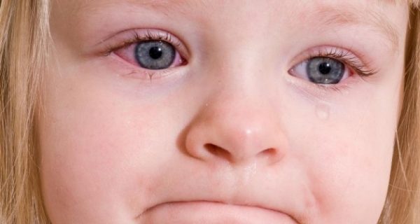 Conjunctivitis in a child
