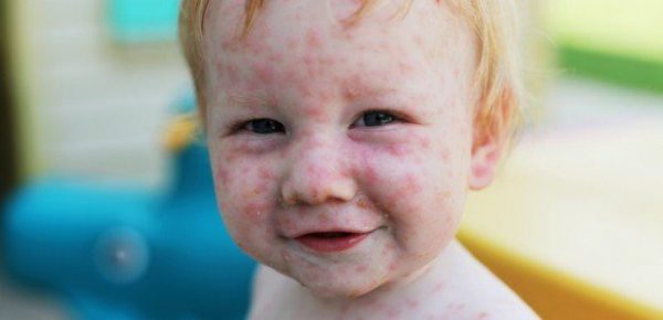Rubella in babies