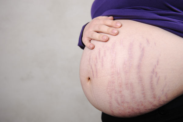 Stretch marks during pregnancy
