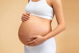 Stretch marks during pregnancy