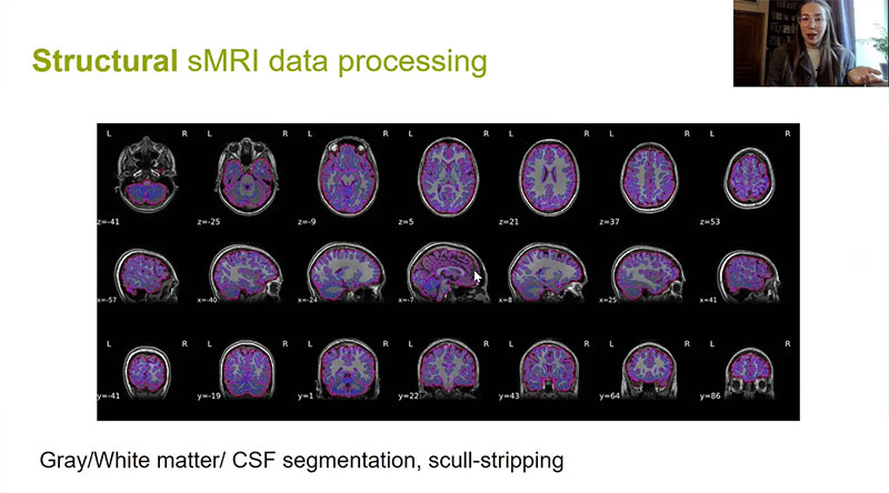 Нейронные сети на снимках МРТ мозга