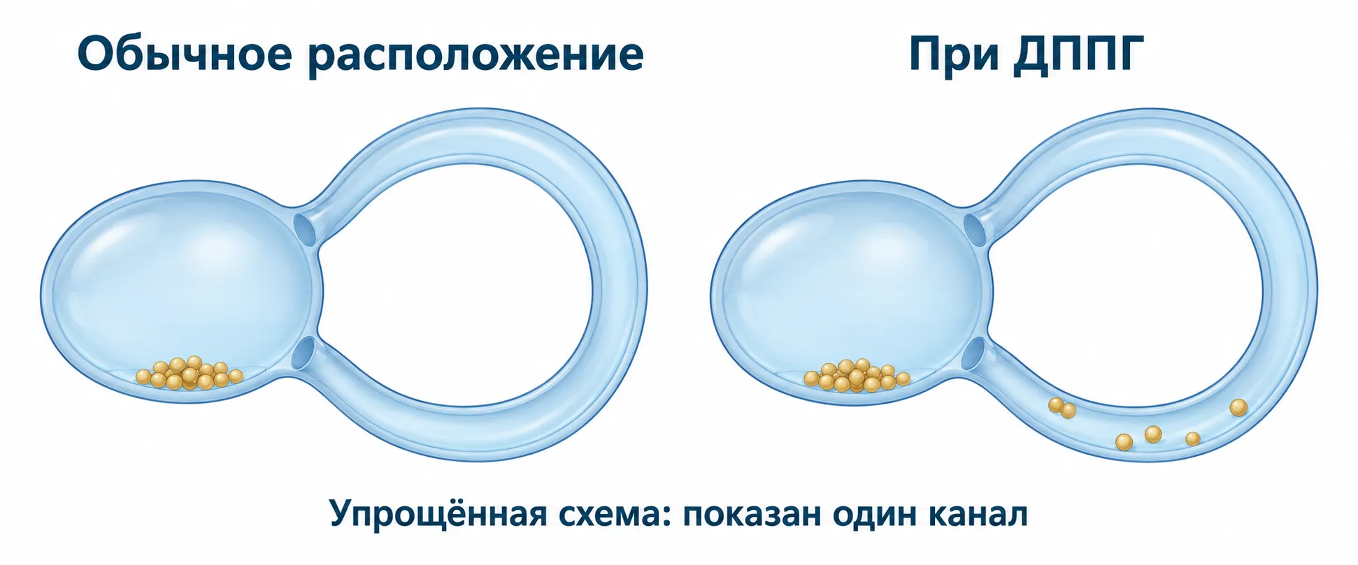 Схема расположения кристаллов во внутреннем ухе и их смещения при ДППГ