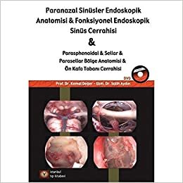 okumak Paranazal Sinüsler Endoskopi Anatomisi &amp; Fonksiyonel Endoskopik Sinüs Cerrahisi