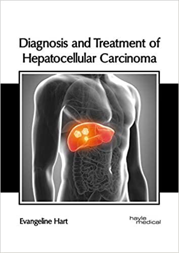 okumak Diagnosis and Treatment of Hepatocellular Carcinoma