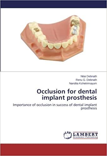 okumak Occlusion for dental implant prosthesis: Importance of occlusion in success of dental implant prosthesis