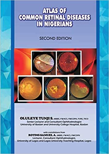 okumak The Atlas of Retinal Diseases in Nigerians