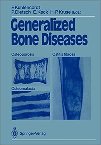 Generalized Bone Diseases: Osteoporosis Osteomalacia Ostitis fibrosa: Osteoporosis, Osteomalacia, Ostitis Fibrosa. Proceedings of 2nd Annual Conference of the German Society for Osteology
